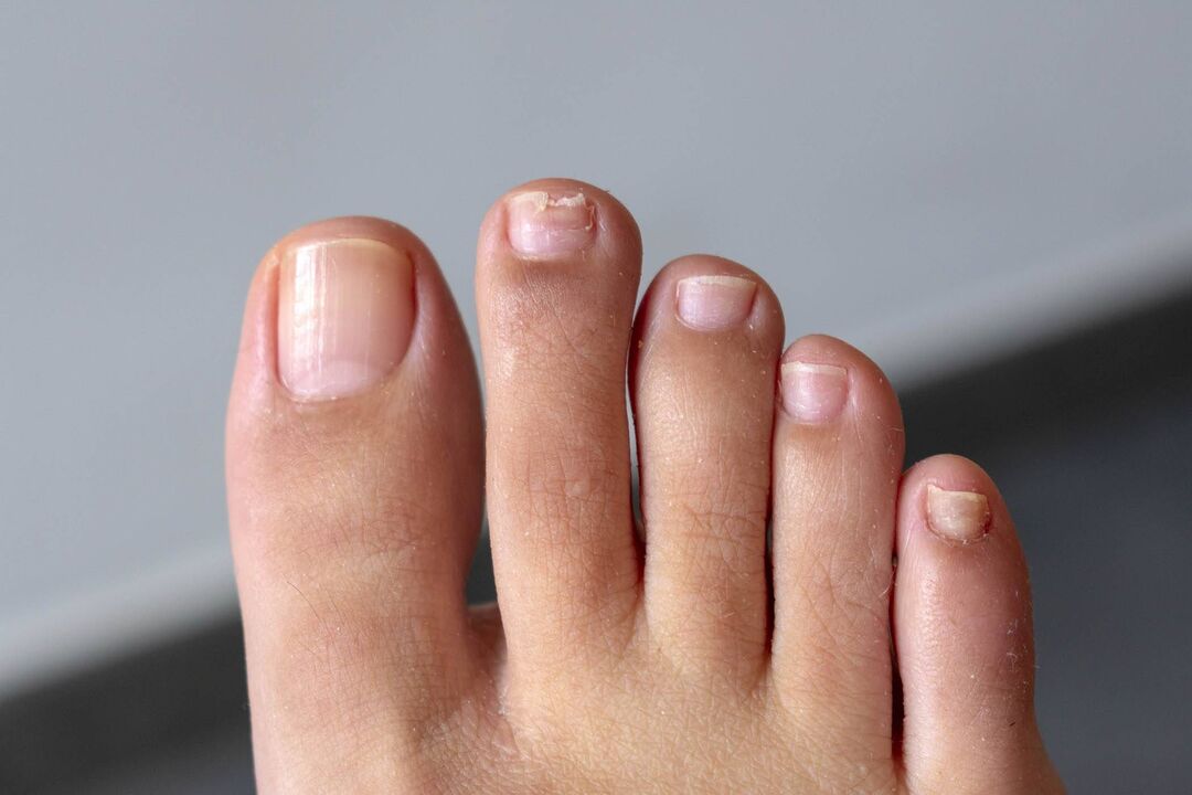 Symptômes de la mycose des ongles des pieds